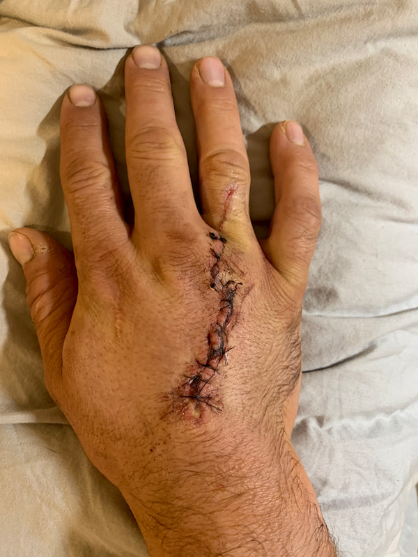 Igor Nazarchuk Right Hand Post surgery