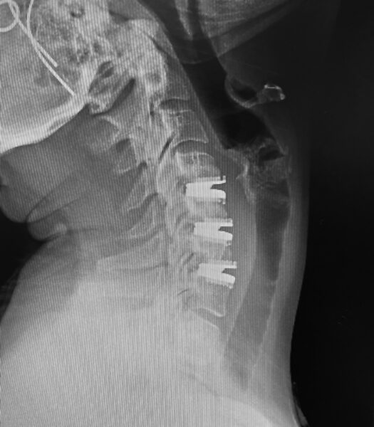 Spinal Disk Replacement