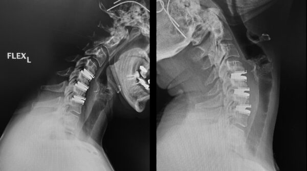 Spine disc replacement xray