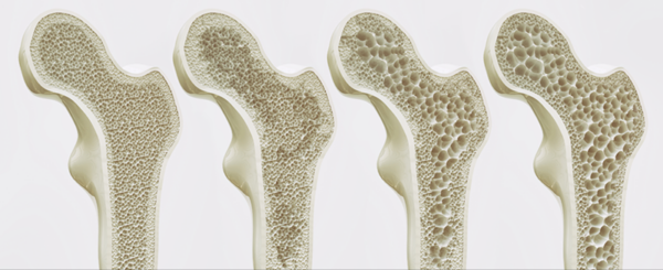 SOSI Osteoporosis