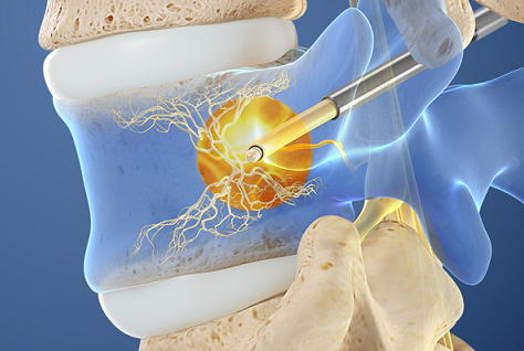 Intacept Procedure