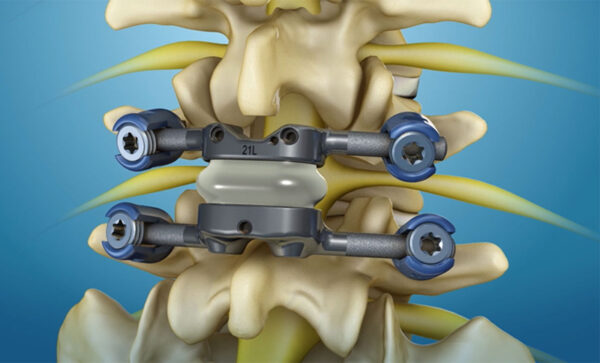 TOPS Spinal Implant